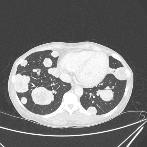 Canonball lung metastasis (Radiopaedia 77634-89837 Axial lung window 132).jpg