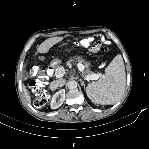 File:Caput medusae sign - portal hypertension (Radiopaedia 64007-72759 A 23).jpg