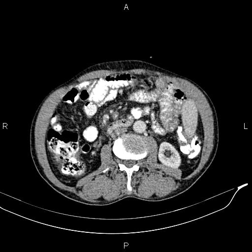 File:Caput medusae sign - portal hypertension (Radiopaedia 64007-72759 A 46).jpg