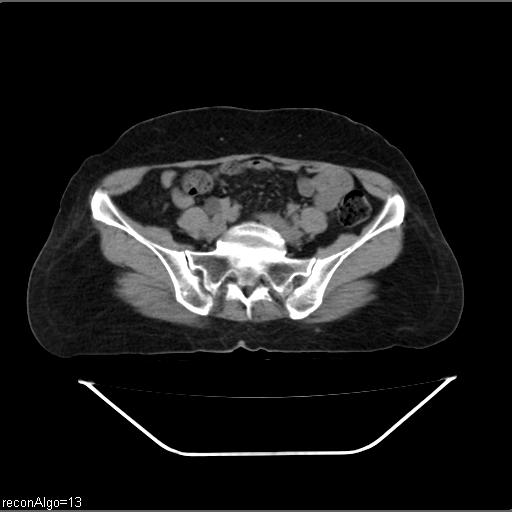 File:Carcinoma cervix- recurrence (Radiopaedia 34702-36137 Axial non-contrast 37).jpg