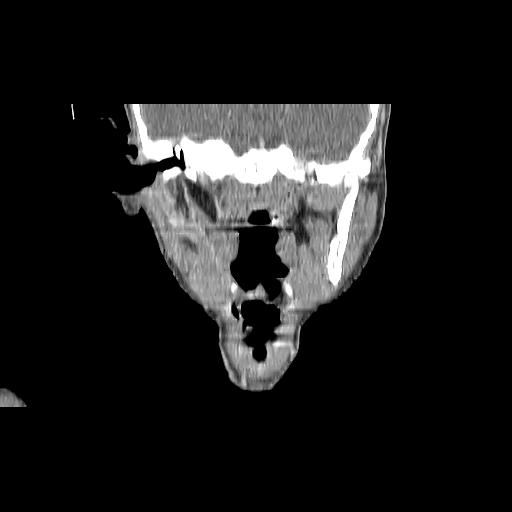 Carcinoma of the maxillary antrum (Radiopaedia 53805-59888 Coronal C+ delayed 87).jpg