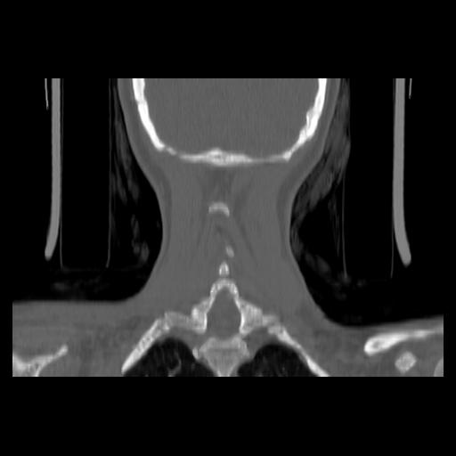 Carcinoma of the maxillary antrum (Radiopaedia 53805-59888 Coronal bone window 130).jpg