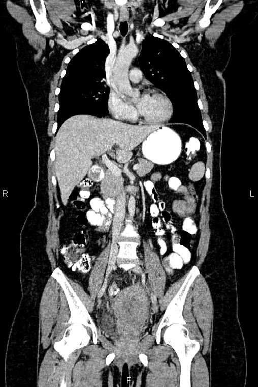 Carcinoma of uterine cervix (Radiopaedia 85861-101700 C 25).jpg