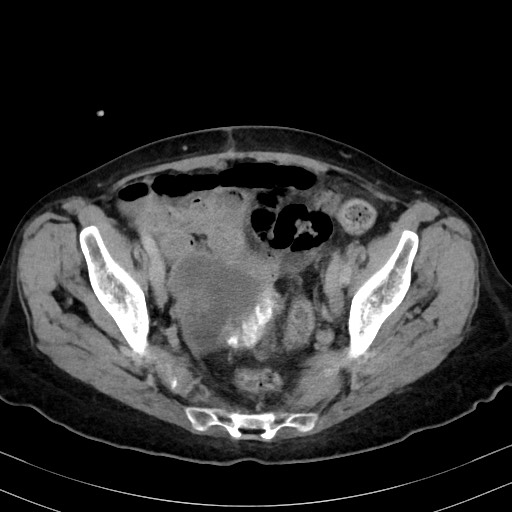 Carcinosarcoma (Radiopaedia 70401-80503 A 55).jpg