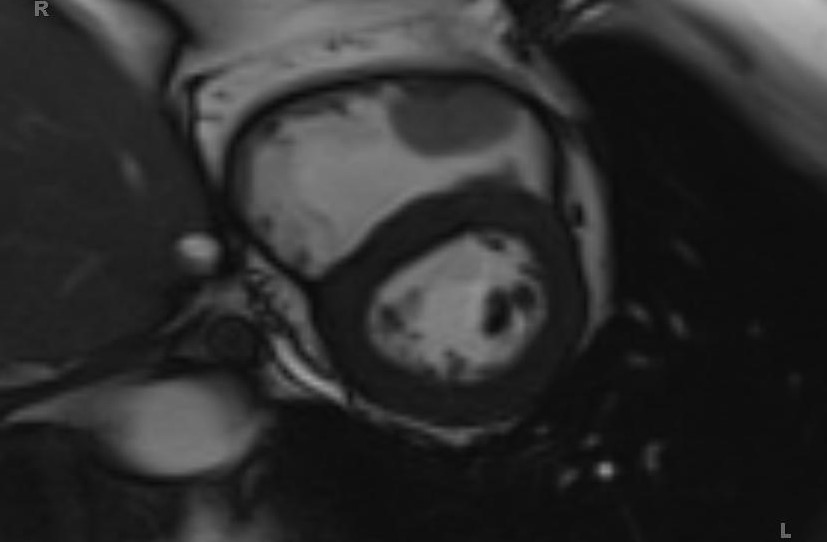 Cardiac hemangioma (Radiopaedia 31709-32631 Short axis Cine SSFP 49).jpg