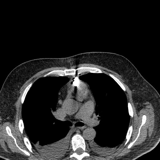File:Cardiac lymphoma (Radiopaedia 38690-40840 Axial non-contrast 4).jpg
