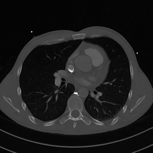 Cardiac tumor - undifferentiated pleomorphic sarcoma (Radiopaedia 45844-50134 Axial bone window 35).png