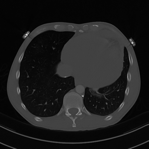 File:Cardiac tumor - undifferentiated pleomorphic sarcoma (Radiopaedia 45844-50134 Axial bone window 53).png