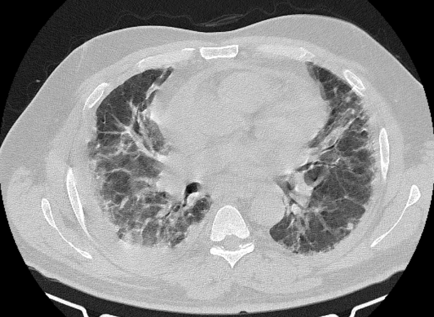 Cardiogenic pulmonary edema (Radiopaedia 68180-77678 Axial lung window 50).jpg