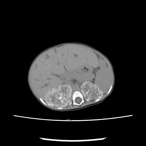 Caroli disease with autosomal recessive polycystic kidney disease (ARPKD) (Radiopaedia 89651-106703 E 79).jpg