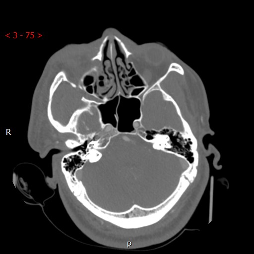 Caroticocavernous fistula (Radiopaedia 42346-45457 A 33).jpg