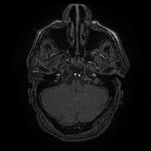Carotid arterial dissection with acute cerebral infarction (Radiopaedia 26636-26784 MRA 143).jpg