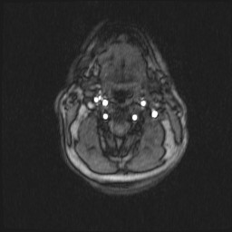 Carotid artery dissection (Radiopaedia 28441-28689 Axial MRA 43).jpg