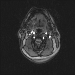 Carotid artery dissection (Radiopaedia 28441-28689 Axial MRA 44).jpg