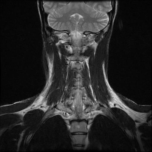 File:Carotid body tumor (Radiopaedia 30208-30823 Coronal T2 7).jpg