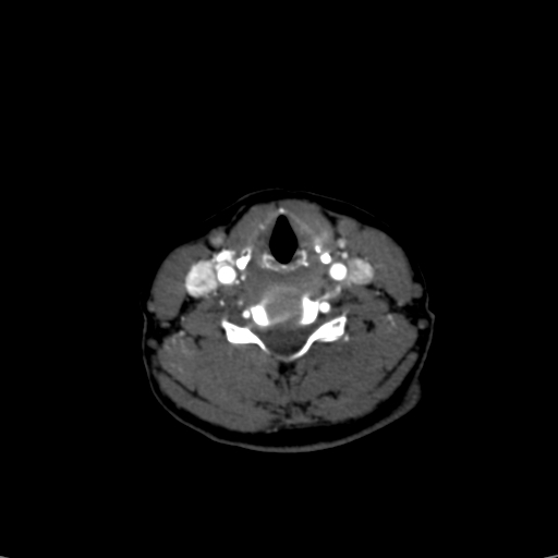 Carotid body tumor (Radiopaedia 39845-42300 B 11).jpg