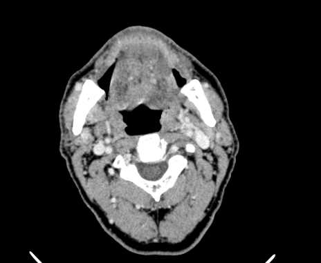 Carotid body tumor (Radiopaedia 61750-69757 Axial Post contrast 31).jpg