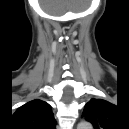 File:Carotid body tumor (paraganglioma) (Radiopaedia 38586-40729 B 34).jpg