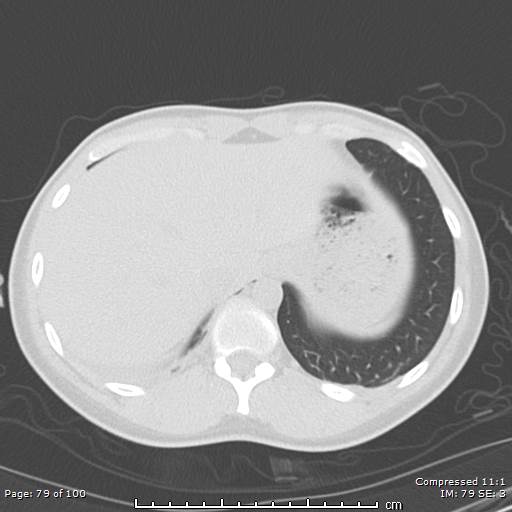 Catamenial pneumothorax (Radiopaedia 54382-60600 Axial non-contrast 79).jpg