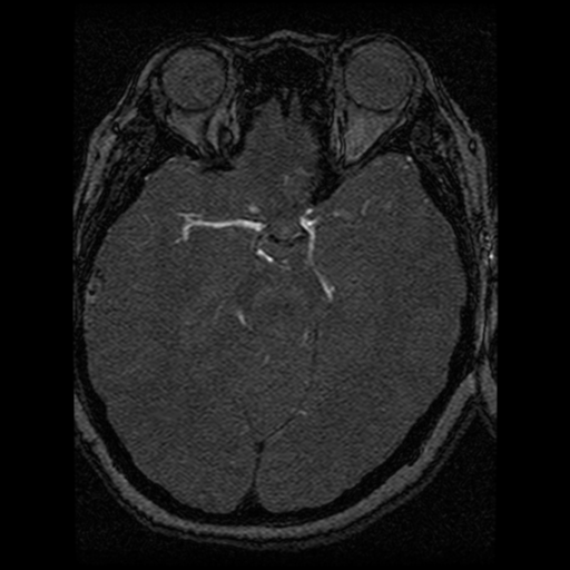 Cavernoma, DVA and right ICA aneurysm (Radiopaedia 33890-35072 E 48).png