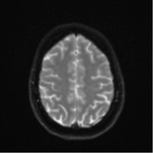 File:Cavernoma with bleed - midbrain (Radiopaedia 54546-60774 Axial DWI 21).png