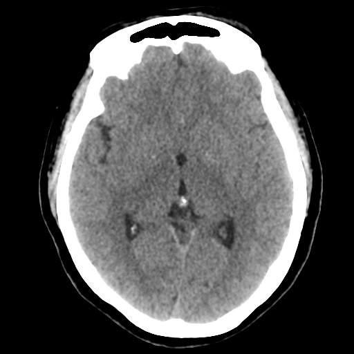 Cavernoma with hemorrhage (Radiopaedia 70755-80931 Axial non-contrast 26).png