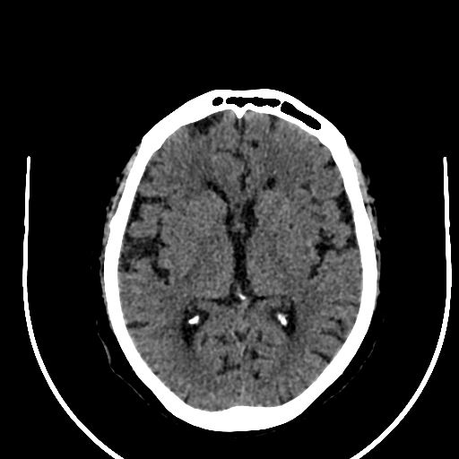 Cavernous hemangioma of the cerebellar falx (Radiopaedia 73025-83723 Axial non-contrast 71).jpg