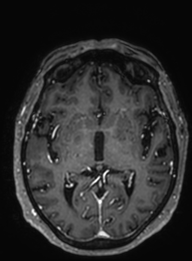 Cavernous hemangioma of the cerebellar falx (Radiopaedia 73025-83724 Axial T1 C+ 176).jpg