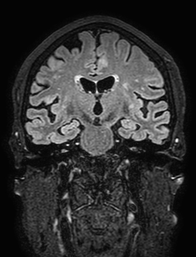 Cavernous hemangioma of the cerebellar falx (Radiopaedia 73025-83724 Coronal FLAIR 176).jpg