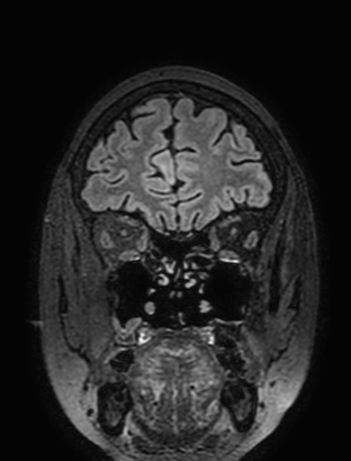 Cavernous hemangioma of the cerebellar falx (Radiopaedia 73025-83724 Coronal FLAIR 64).jpg