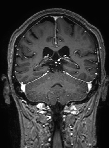Cavernous hemangioma of the cerebellar falx (Radiopaedia 73025-83724 Coronal T1 C+ 246).jpg