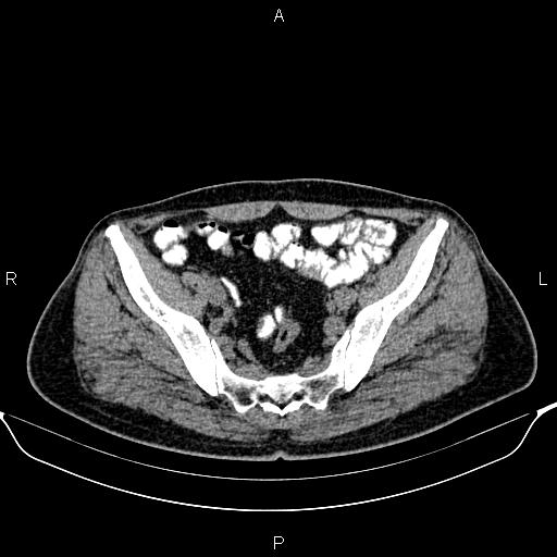 Cecal adenocarcinoma (Radiopaedia 85324-100916 Axial non-contrast 80).jpg
