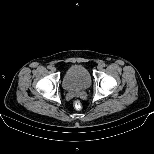 Cecal adenocarcinoma (Radiopaedia 85324-100916 Axial non-contrast 94).jpg