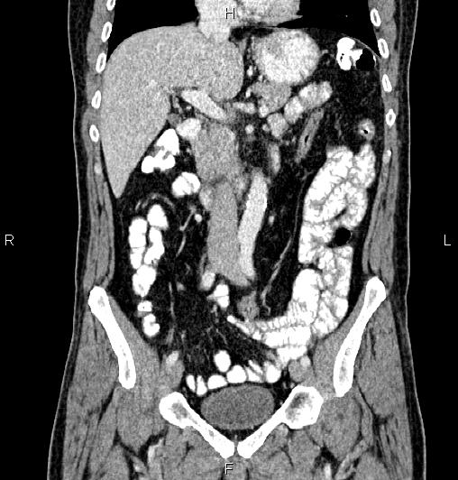 Cecal adenocarcinoma (Radiopaedia 85324-100916 D 28).jpg