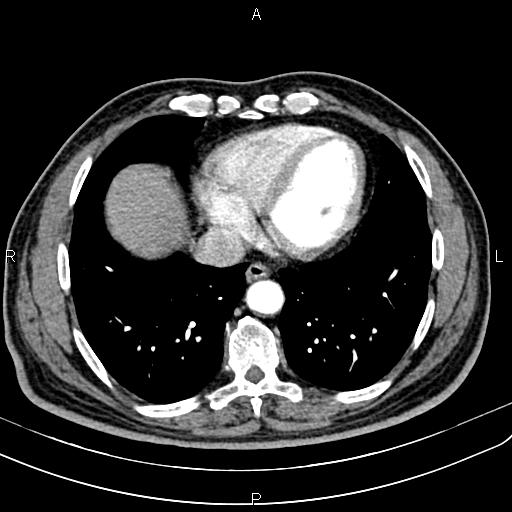File:Cecal cancer with appendiceal mucocele (Radiopaedia 91080-108651 A 48).jpg