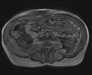 Cecal mass causing appendicitis (Radiopaedia 59207-66532 K 76).jpg