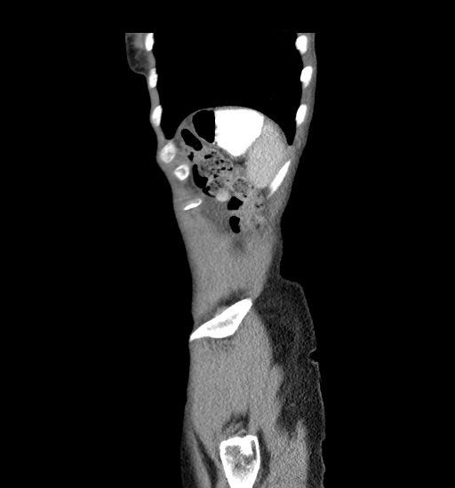 Cecal volvulus (Radiopaedia 48543-53513 C 47).jpg