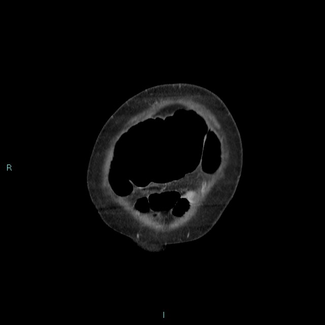 Cecal volvulus (Radiopaedia 71372-81698 C 10).jpg