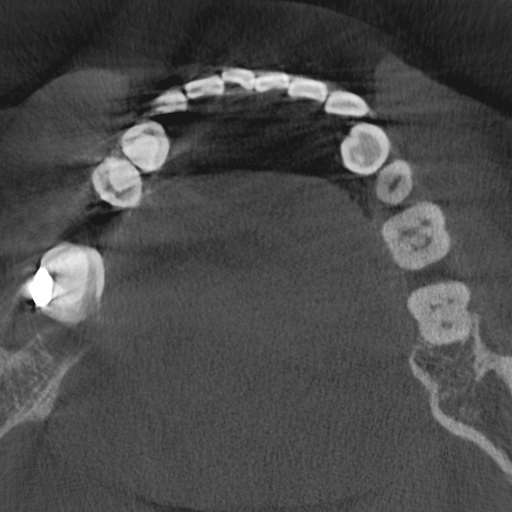 Cemento-osseous dysplasia (Radiopaedia 48251-53126 Axial non-contrast 60).jpg
