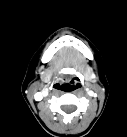 Cemento-ossifying fibroma (Radiopaedia 46243-50643 Axial C+ delayed 45).png