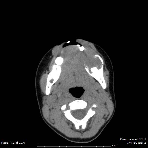 File:Central giant cell granuloma (Radiopaedia 45612-49754 Axial non-contrast 21).jpg