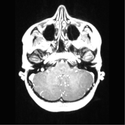 Central neurocytoma (Radiopaedia 37664-39557 Axial T1 C+ 19).png