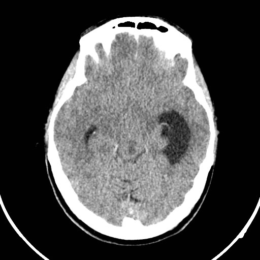 Central neurocytoma (Radiopaedia 84497-99871 Axial non-contrast 18).jpg