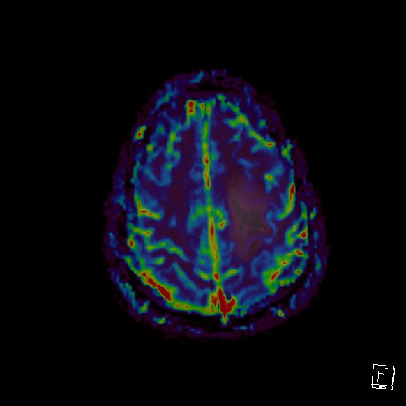 Central neurocytoma (Radiopaedia 84497-99872 Axial Perfusion 57).jpg