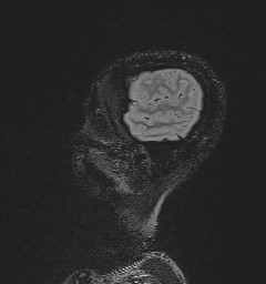 Central neurocytoma (Radiopaedia 84497-99872 Sagittal Flair + Gd 24).jpg
