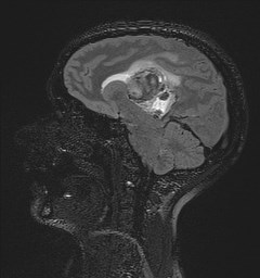 File:Central neurocytoma (Radiopaedia 84497-99872 Sagittal Flair + Gd 87).jpg