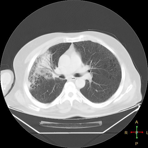 File:Centrilobular emphysema - with superimposed infection (Radiopaedia 24389-24683 lung window 13).jpg