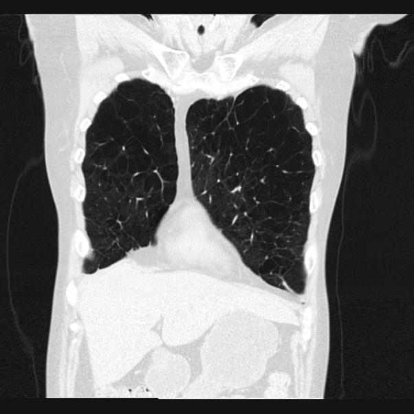 Centrilobular pulmonary emphysema (Radiopaedia 24495-24789 Coronal lung window 14).jpg