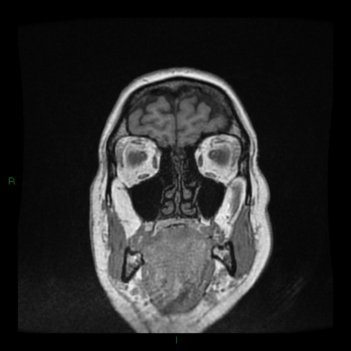 File:Cerebellar abscess (Radiopaedia 78135-90678 Coronal T1 C+ 22).jpg
