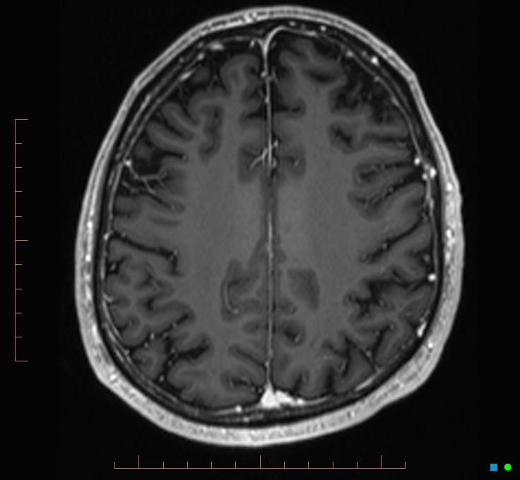 Cerebellar gangliocytoma (Radiopaedia 65377-74422 Axial T1 C+ 99).jpg